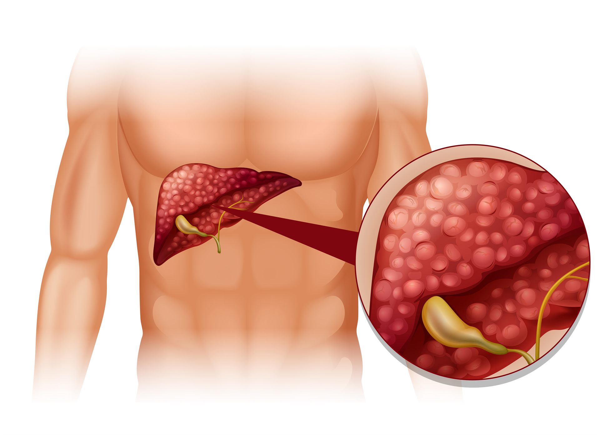 Fatty Liver Management